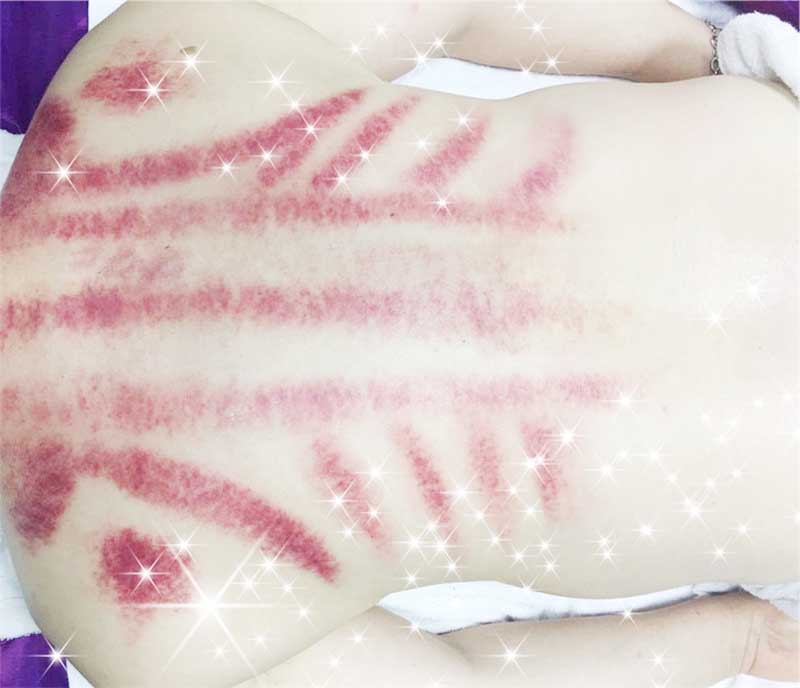 美容刮痧